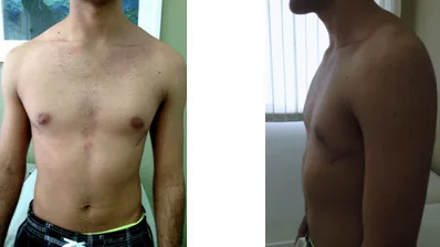 14o Pos operatorio cirurgia de Nuss Correcao Cirurgica da Deformidade Toracica