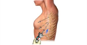 Simpatectomia Torácica