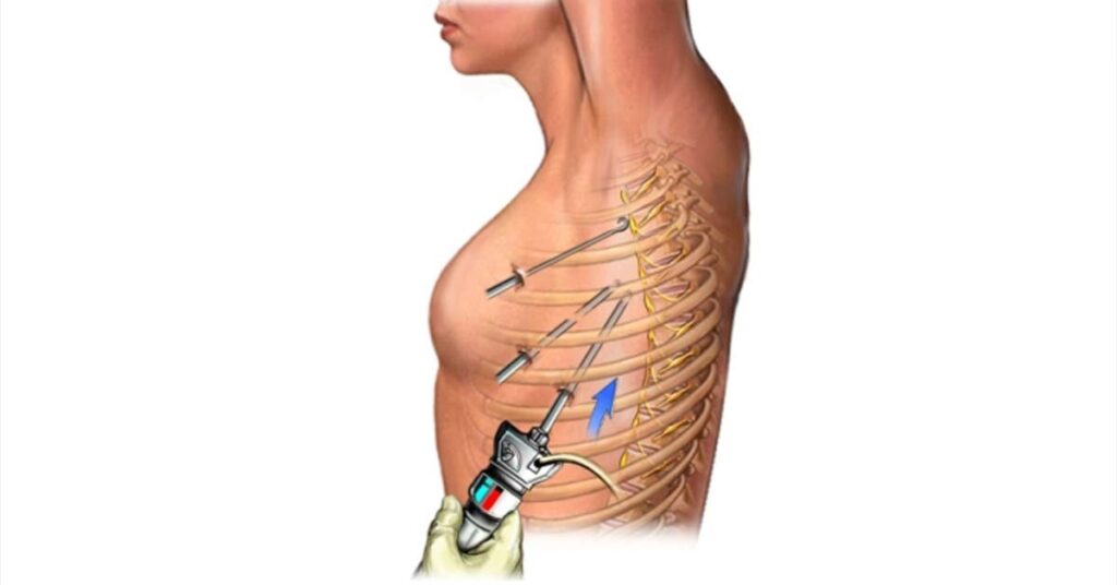 Simpatectomia Torácica