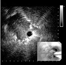 Ultrassonografia Endobrônquica (EBUS)