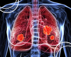 Nódulos pulmonares: quando fazer biópsia e acompanhamento