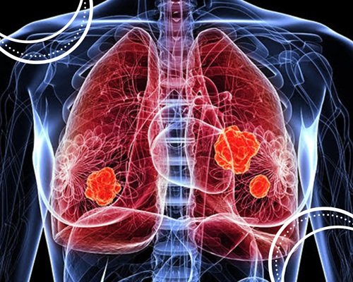 Nódulos pulmonares: quando fazer biópsia e acompanhamento