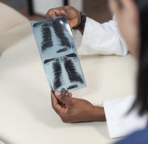 Pneumotorax espontaneo em jovens causas e prevencao