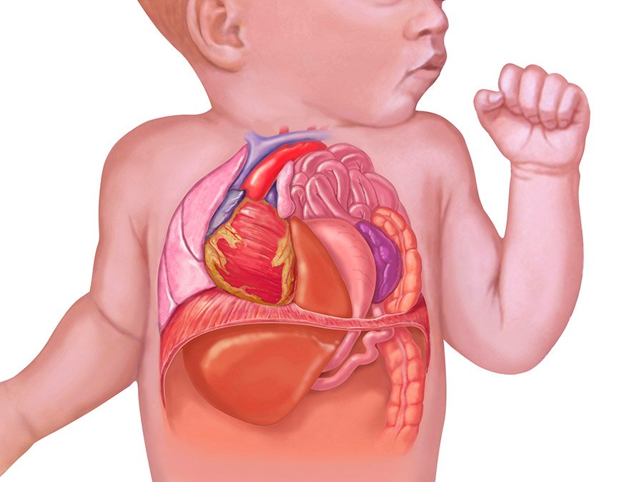 Hérnia Diafragmática 1 Hernia Diafragmatica