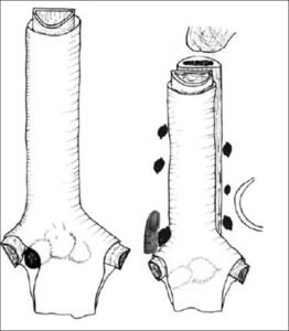 mediastinoscopia1