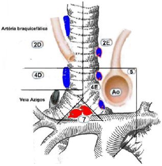 mediastinoscopia2