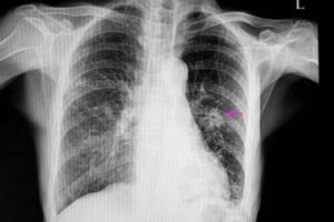 nodulo pulmonar solitario exame