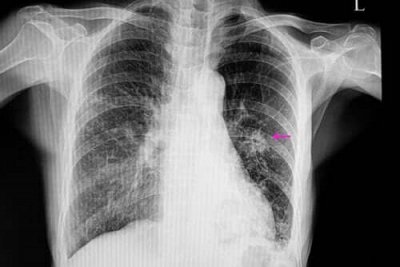 Nódulo Pulmonar Solitário