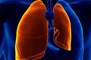 pneumotorax
