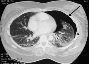 pneumotorax espontaneo1