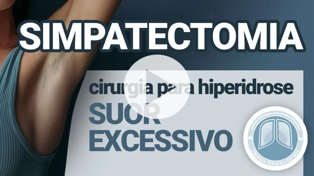 simpatectomia video1170