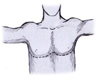 toracotomia transversa