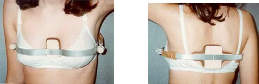 Compressor Dinamico do Torax CDT para tratamento de Pectus Carinatum Deformidade Congenita Parede Toracica