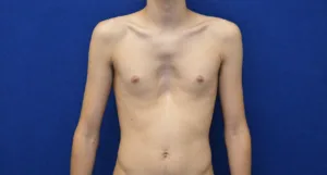 Deformidades toracicas congenitas em adultos