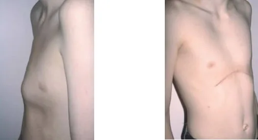 Esternocondroplastia para Correcao de Pectus Carinatum Deformidade Toracica