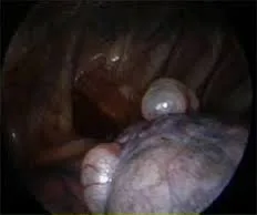 Pneumotórax Espontâneo 1 Imagem intra operatoria de uma bleb Pneumotorax espontaneo