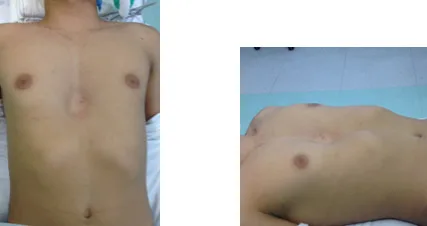 Pre opertorio cirurgia de Nuss