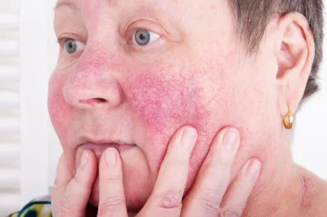 Rubor Facial 1