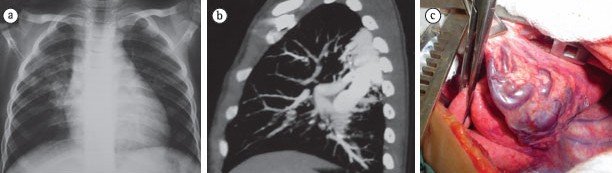 Malformações congênitas no pulmão 1 Sequestro pulmonar Malformacoes congenitas no pulmao