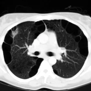 Pneumotórax Espontâneo 2 Tomografia computadorizada de paciente com DPOC e bolhas pulmonares