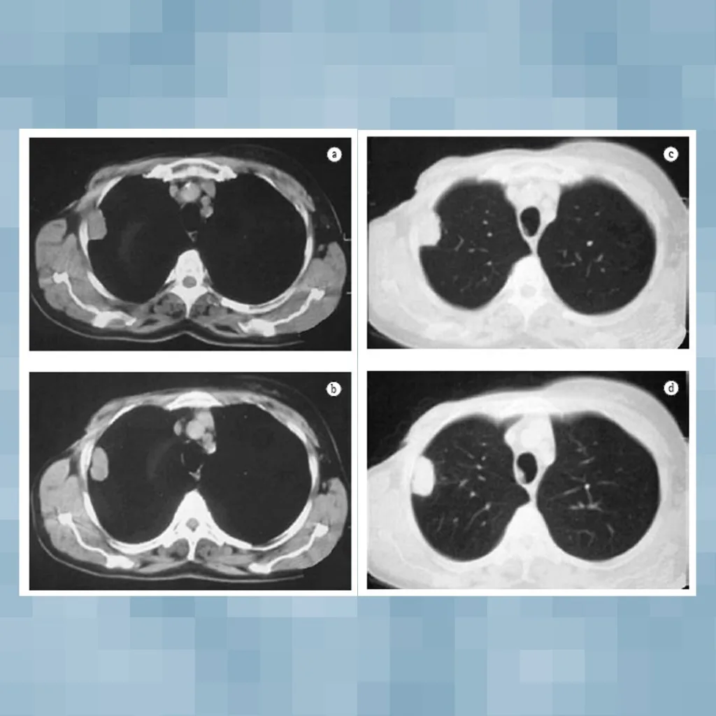 Tumores pulmonares benignos 2