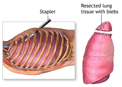Pneumotórax Espontâneo 3 bulectomia resseccao pulmonar pneumotorax Espontaneo