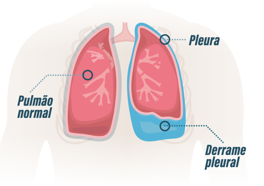 Derrame Pleural: entenda o quadro