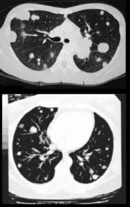 metastases pulmonares