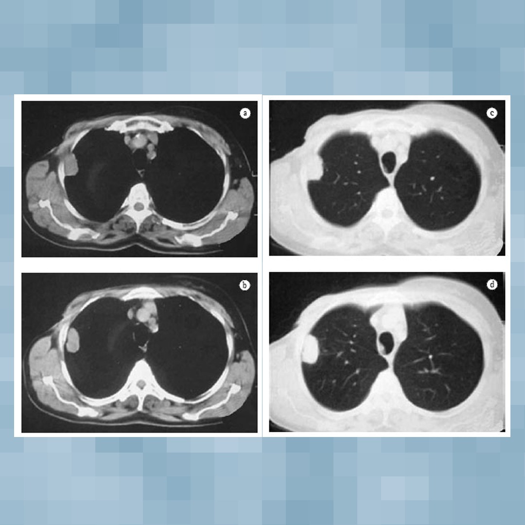Tumores%20pulmonares%20benignos%202