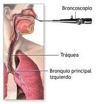 broncoscopia diagnostica terapeutica20220413
