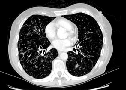 bronquiectasias20211213