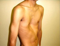 deformidades congenitas parede toracica20220420