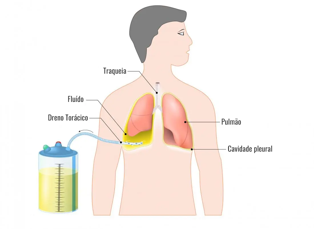 Exemplo de Dreno Torácico