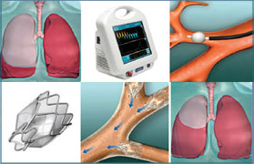 enfisema pulmonar broncoscopia20220420