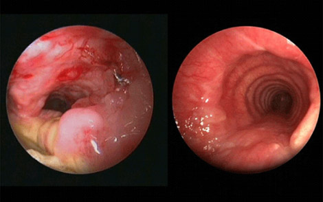 estenose traqueia20211210