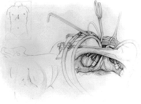 esternotomia20220119