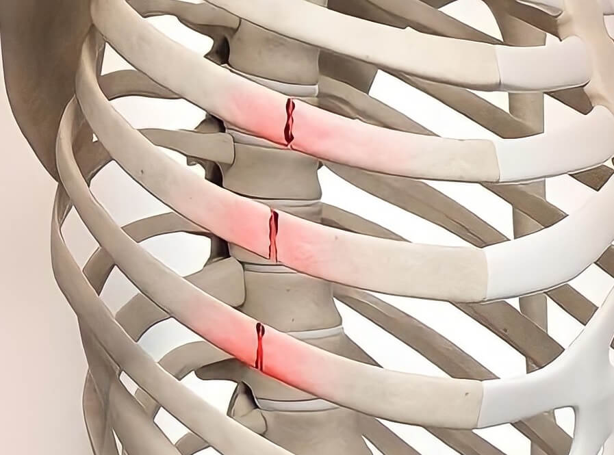 fratura traumatica arcos costais20230618