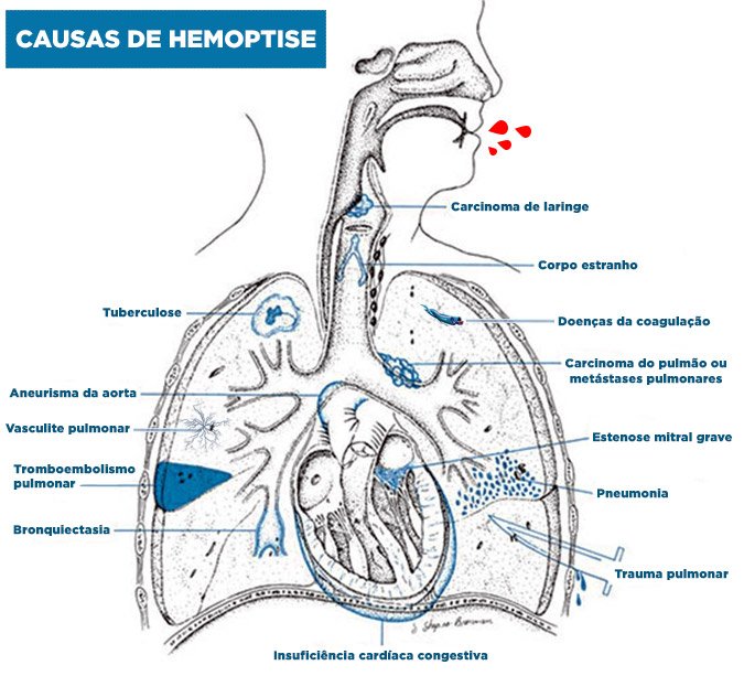 hemoptise causa tosse com sangue20220223