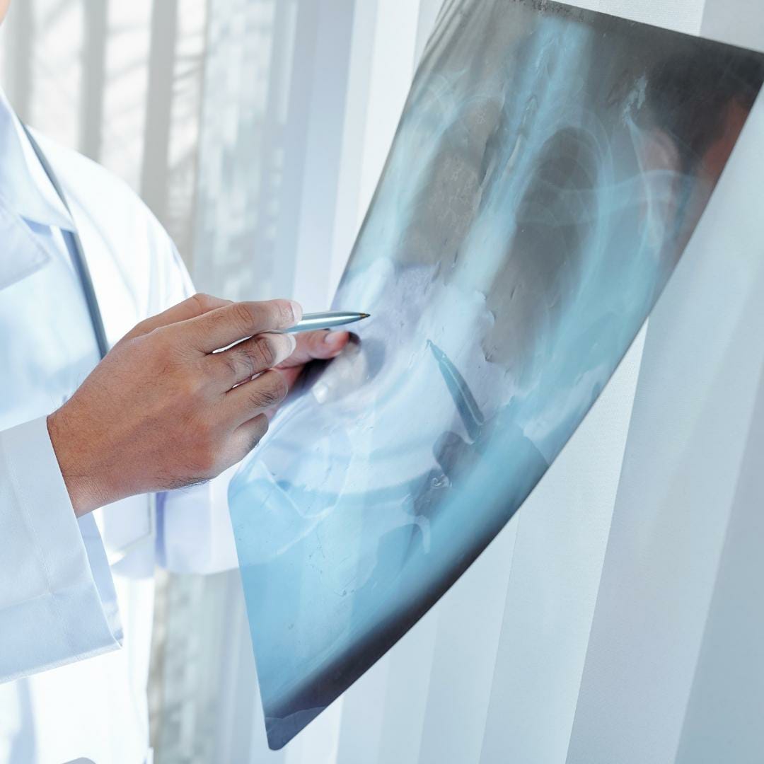 malformacoes congenitas pulmao20220316