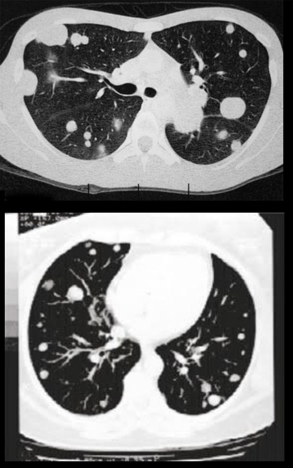 metastases pulmonares20220330