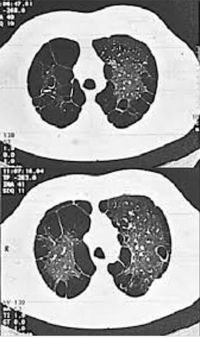 pneumoplastia cirurgia redutora volume pulmonar20220223