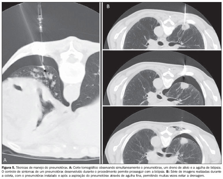 Bi%C3%B3psia Transtor%C3%A1cica1