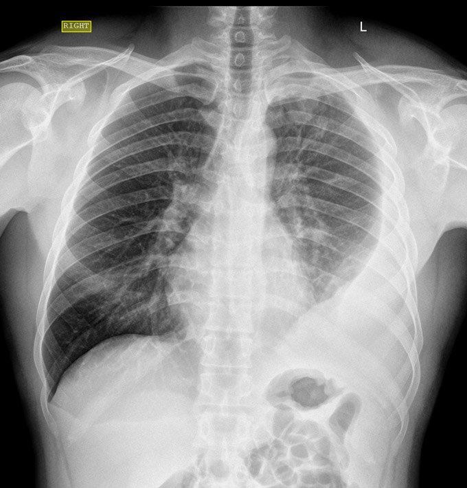 Derrame Pleural