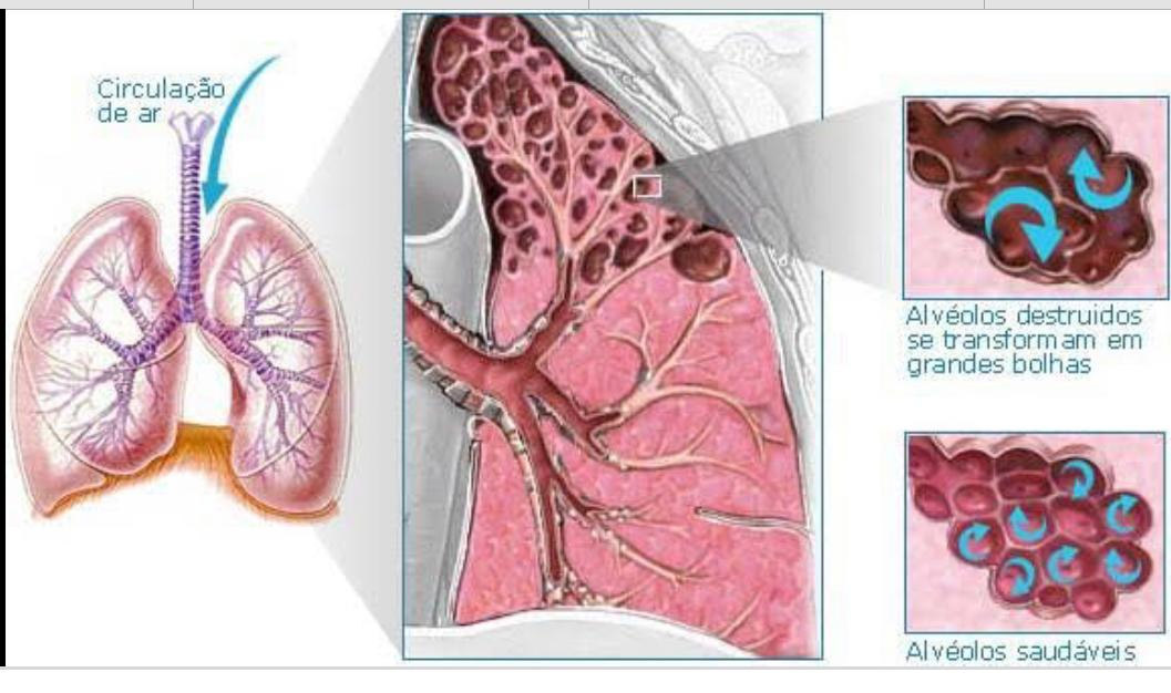 cirurgiaredutoravolumepulmonar pneumoplastia