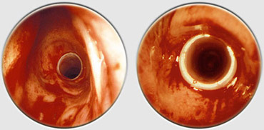 colocacao ortese traqueal2