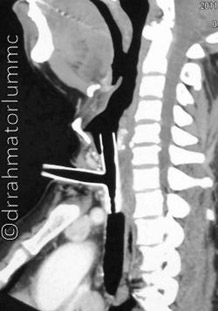 colocacao ortese traqueal3