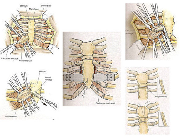 correcao cirurgica deformidade toracica1
