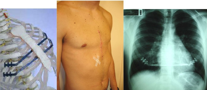 correcao cirurgica deformidade toracica2