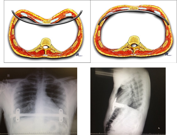 correcao cirurgica deformidade toracica3