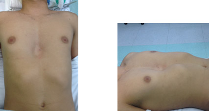 correcao cirurgica deformidade toracica4